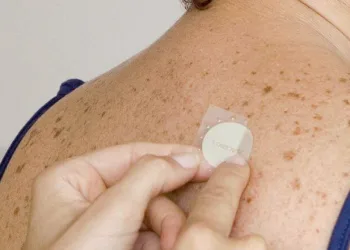 Adesivo para tratamento de Alzheimer já está disponível pelo SUS.