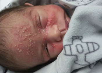 Bebê de 17 dias contrai herpes após beijo de visita e mãe alerta