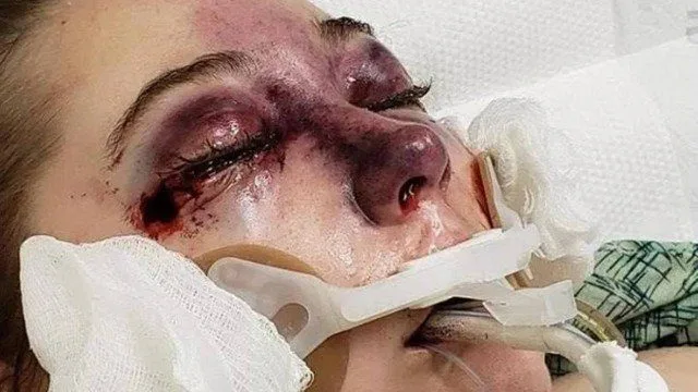 Adolescente ‘chora sangue’ após contrair misteriosa doença durante cruzeiro