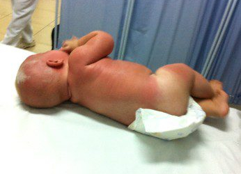Bebê que teve queimaduras após exposição ao sol deixa o hospital