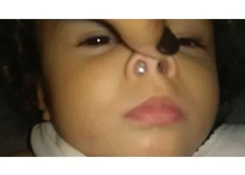 Mãe faz alerta após perceber objeto inusitado no nariz da filha de 1 ano