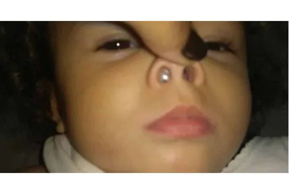 Mãe faz alerta após perceber objeto inusitado no nariz da filha de 1 ano