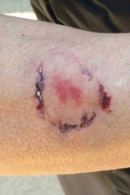 Mulher é atacada por cão e mordida pela dona do animal