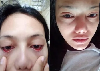 MULHER TEM OLHOS COLADOS E PERDE OS CÍLIOS APÓS PROCEDIMENTO