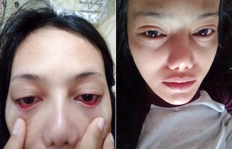 MULHER TEM OLHOS COLADOS E PERDE OS CÍLIOS APÓS PROCEDIMENTO