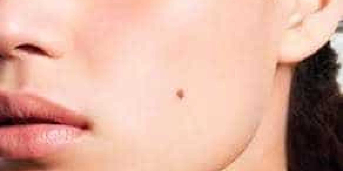 12 perguntas e respostas sobre o câncer de pele