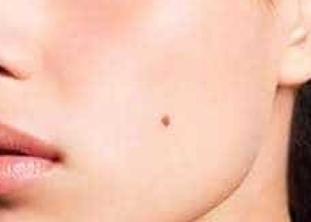 12 perguntas e respostas sobre o câncer de pele