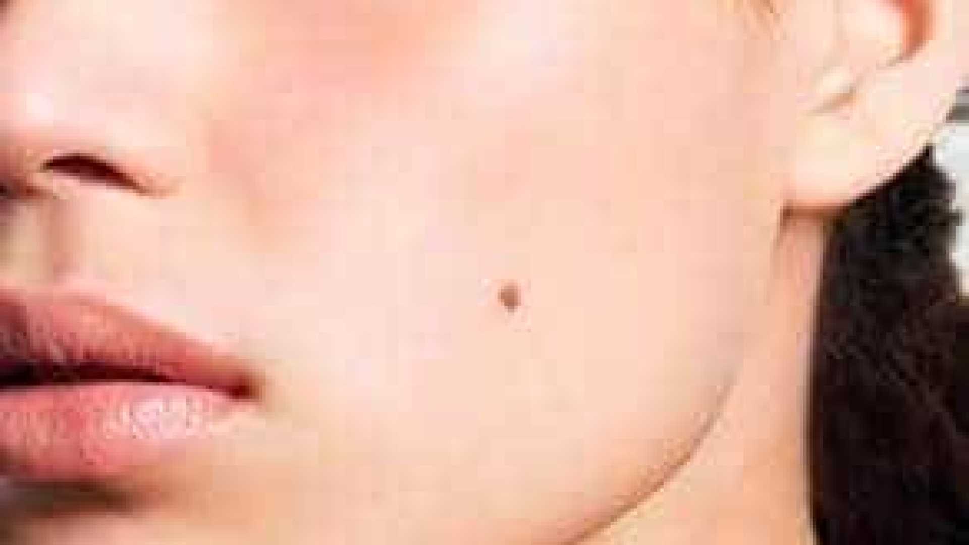 12 perguntas e respostas sobre o câncer de pele