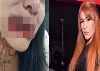 Delegada pede prisão de Blogueira que arrancou 80% do lábio de mulher(IMAGEM FORTE)
