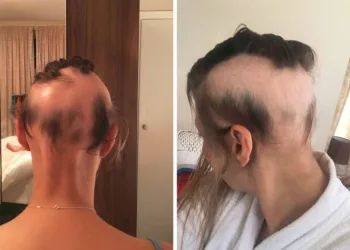 Por conta do estresse com casamento, noiva perde 90% do cabelo