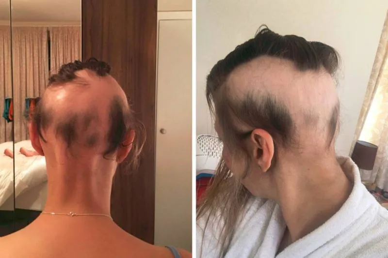 Por conta do estresse com casamento, noiva perde 90% do cabelo