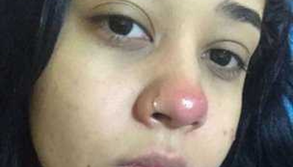 MENINA FICA PARAPLÉGICA AO COLOCAR PIERCING