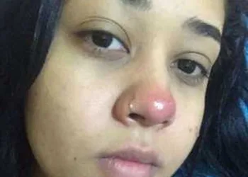 MENINA FICA PARAPLÉGICA AO COLOCAR PIERCING