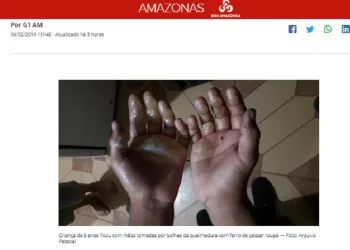 Mulher é acusada de queimar as mãos do filho com ferro de passar roupa