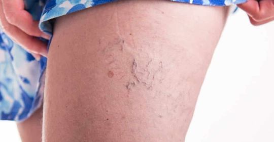 APRENDA A FAZER O ÁLCOOL DE ALECRIM E ELIMINE A GOTA, VARIZES, DOR MUSCULAR E CELULITE.