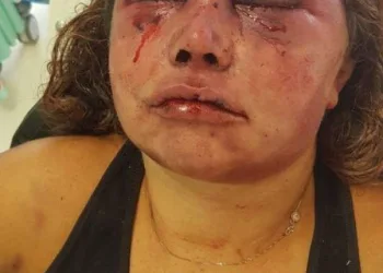 Reconstrução de rosto de mulher espancada na Barra vai durar seis meses, diz médico