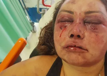 Vítima de espancamento fica abalada após ver pela primeira vez o rosto desfigurado