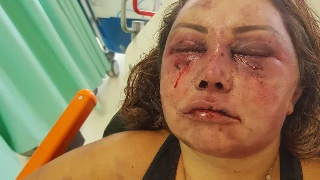 Vítima de espancamento fica abalada após ver pela primeira vez o rosto desfigurado