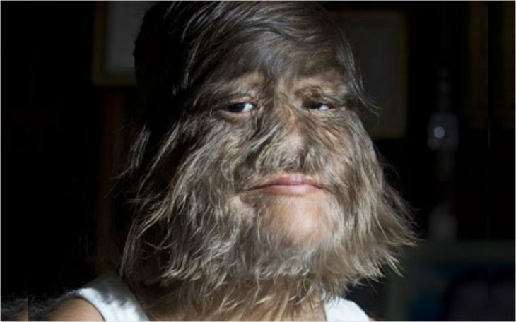 Mulher mais peluda do mundo se depila para o casamento; veja como ela ficou