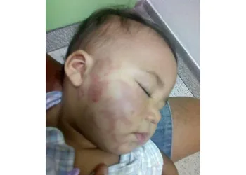 Mãe se depara com bebê cheio de mordidas ao buscá-lo na creche e desabafa nas redes sociais
