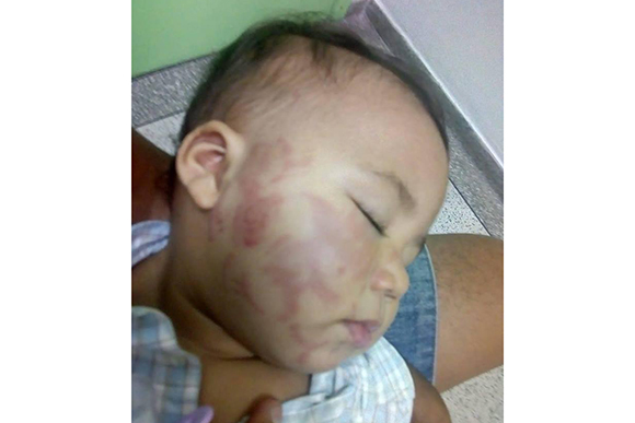 Mãe se depara com bebê cheio de mordidas ao buscá-lo na creche e desabafa nas redes sociais