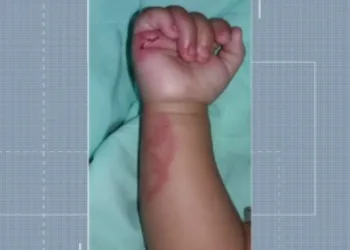Bebê 6 meses é mordido cerca de dez vezes por colega de 2 anos dentro da creche