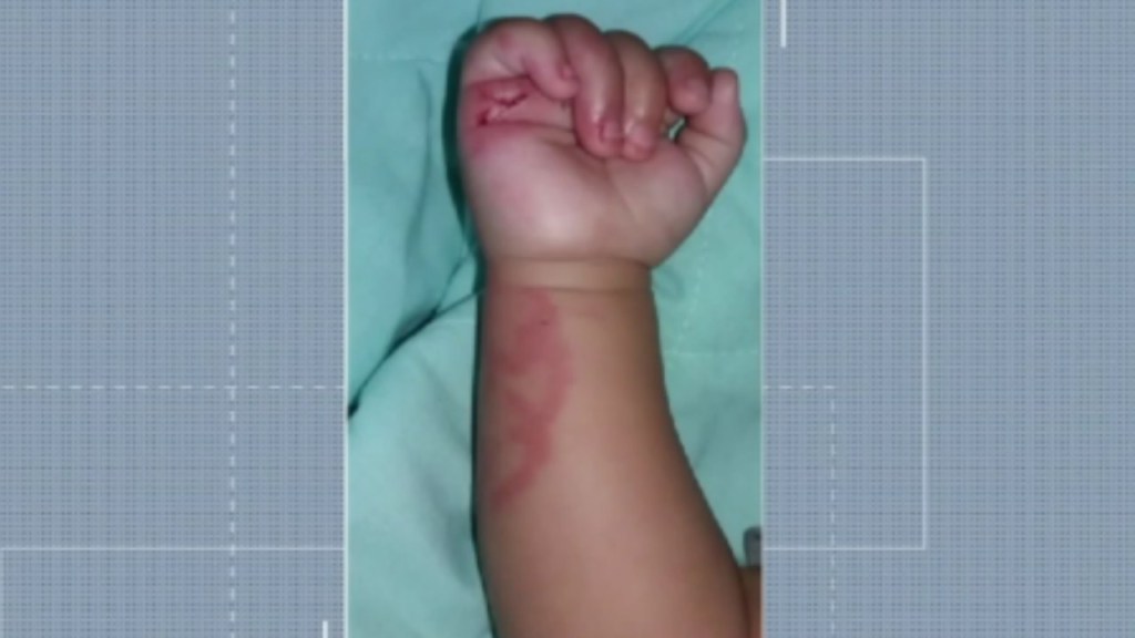 Bebê 6 meses é mordido cerca de dez vezes por colega de 2 anos dentro da creche