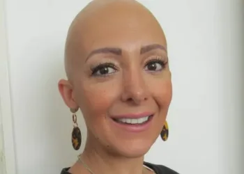 Mulher fica totalmente careca seis meses após nascimento do filho