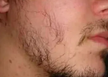 Jovem processa os pais por não ter uma barba de homem.