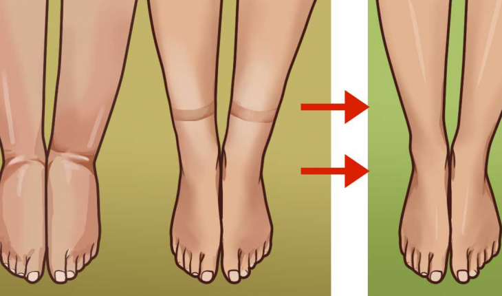Retenção de líquidos, aprenda como combater esse problema e viver melhor
