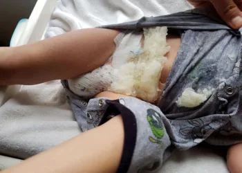 Pai publica alerta após fralda do filho explodir com ‘gelatina cristalizada’