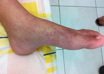Chikungunya provoca duas mortes no Rio