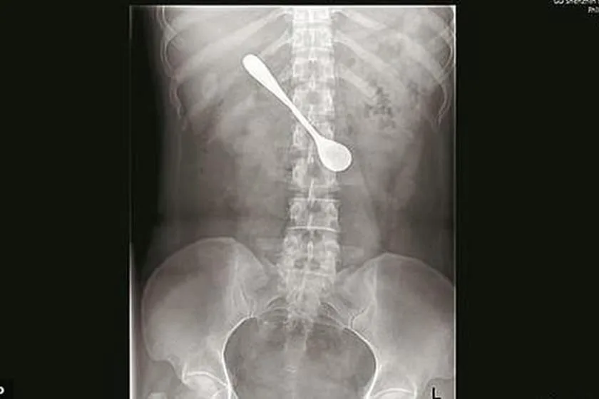 Mulher engole colher ao tentar tirar espinha de peixe da garganta