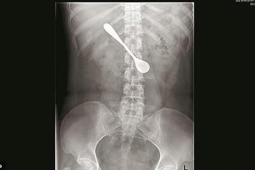 Mulher engole colher ao tentar tirar espinha de peixe da garganta