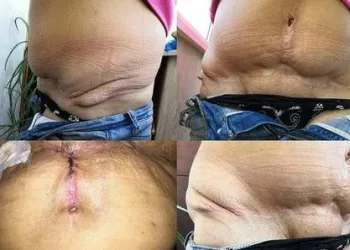 Doutora Frankstein é presa por praticar cirurgias plásticas sem ser médica
