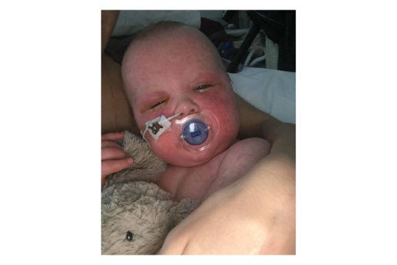 Bebê pega sarampo por irresponsabilidade de outros pais e mãe implora: “Vacinem seus filhos”