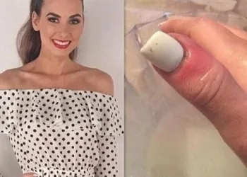 Miss descobre câncer escondido embaixo de unha de gel; como identificar?