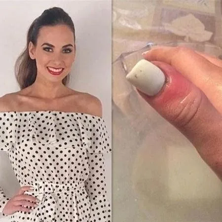 Miss descobre câncer escondido embaixo de unha de gel; como identificar?