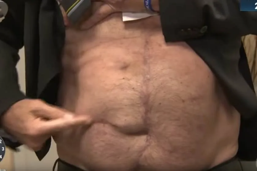 Bolsonaro mostra cicatriz na TV e diz: “Tem gente que não acredita”