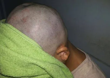 Pai raspa o cabelo da filha após ela fazer bullying com menina com câncer