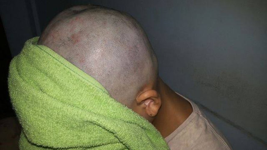 Pai raspa o cabelo da filha após ela fazer bullying com menina com câncer