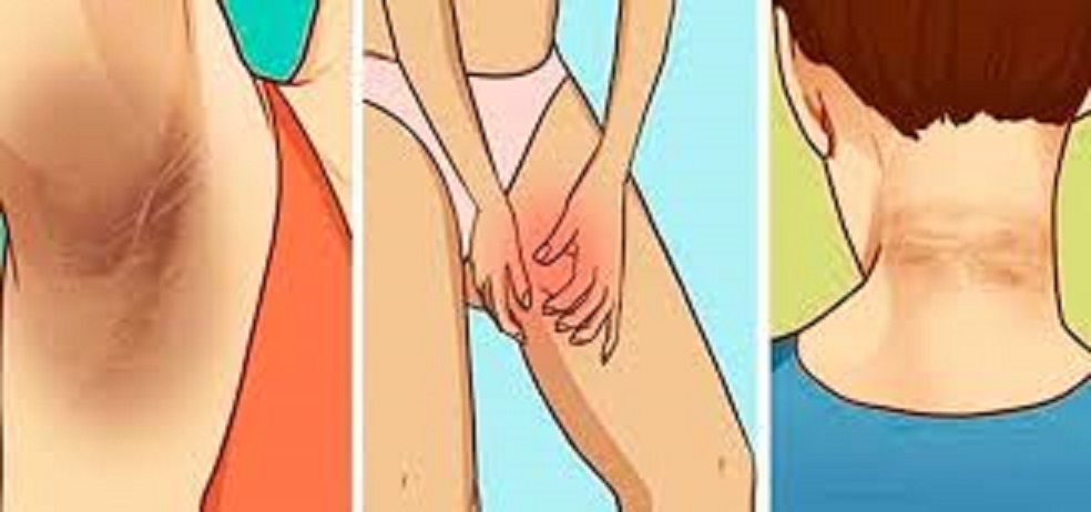 Dicas para eliminar manchas escuras no: Pescoço,coxas e virilha!