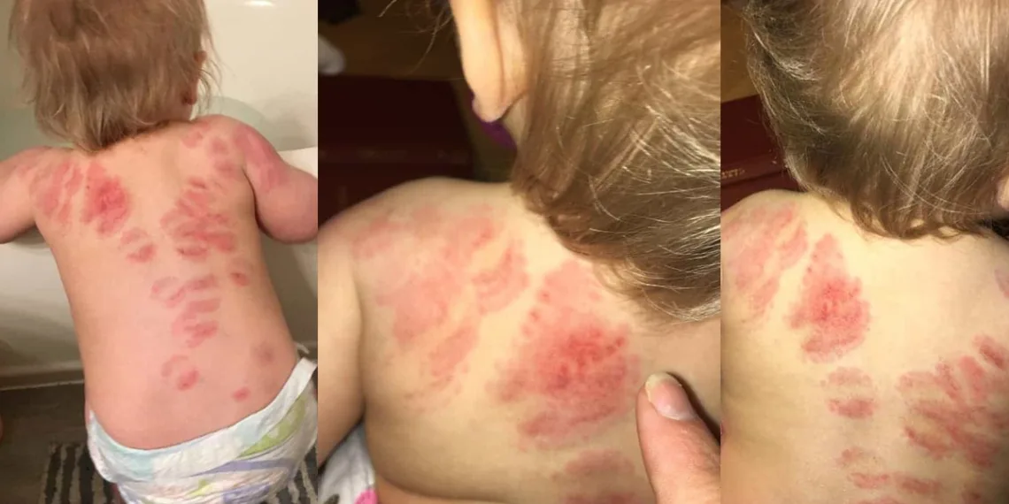 “Fui buscar minha bebê na creche e a encontrei com 25 mordidas”