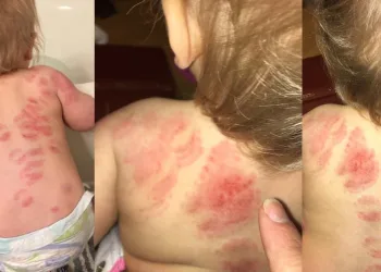 “Fui buscar minha bebê na creche e a encontrei com 25 mordidas”