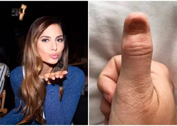 Técnica de manicure pode ter causado câncer agressivo em ex-miss