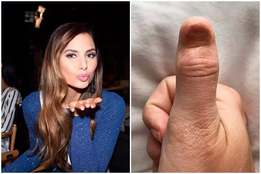 Técnica de manicure pode ter causado câncer agressivo em ex-miss