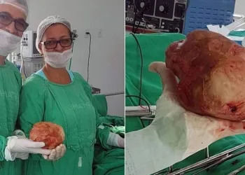 Médico pede ajuda a Deus e retira pedra de 1,3 kg de paciente