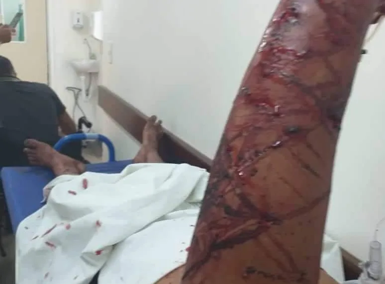 HOMEM QUASE FOI MORTO POR CÃO DA RAÇA PITBULL (FOTO)