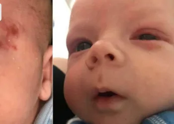 Bebê contrai herpes no olho depois que recebeu beijo, a criança quase ficou cega