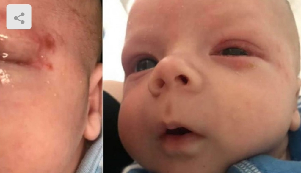 Bebê contrai herpes no olho depois que recebeu beijo, a criança quase ficou cega